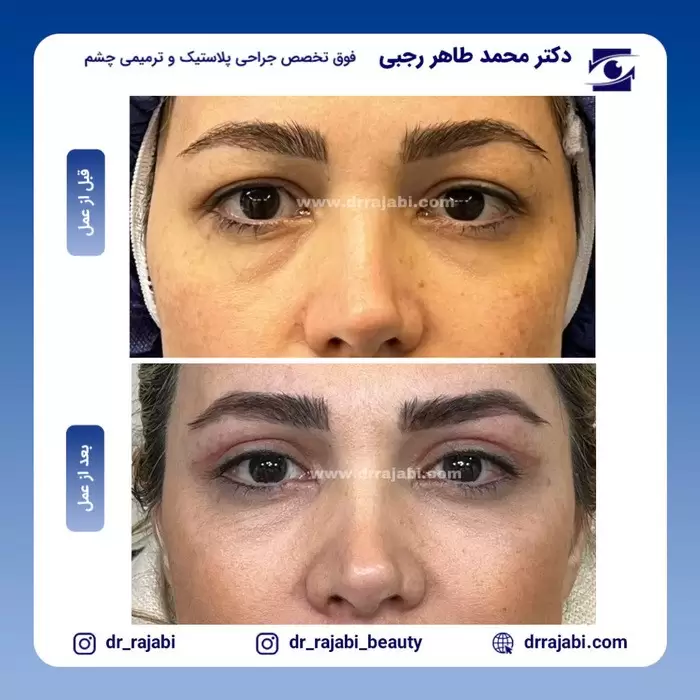 نتیجه جراحی بلفاروپلاستی